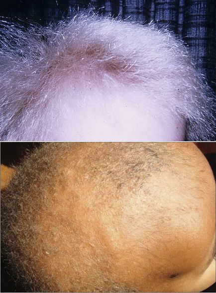 Monietriks - când părul este rău din cauza genelor deteriorate