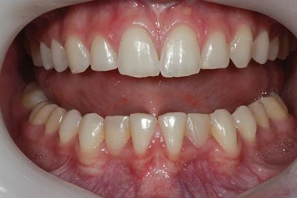 O nouă abordare a restaurării dinților frontali - terapie - știri și articole despre stomatologie -