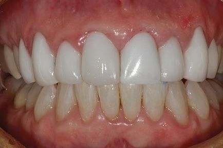 Новий підхід до реставрації фронтальних зубів - терапія - новини і статті по стоматології -