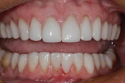 O nouă abordare a restaurării dinților frontali - terapie - știri și articole despre stomatologie -