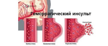 Excesive cauze accident vascular cerebral, simptome și tratament