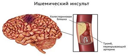 Excesive cauze accident vascular cerebral, simptome și tratament