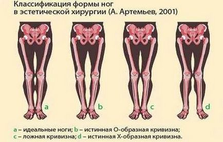 Операція по випрямляння кривизни ніг