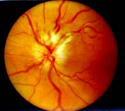 Optiocoelita (boala fetei) simptomele si cauzele bolii neuromusculare optice