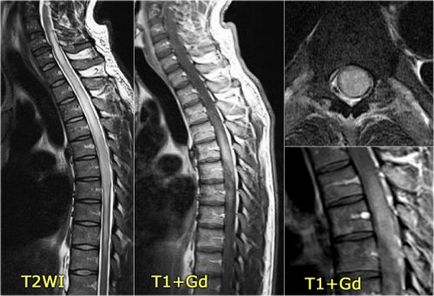 Optiocoelita (boala fetei) simptomele si cauzele bolii neuromusculare optice