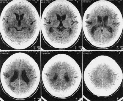 Optiocoelita (boala fetei) simptomele si cauzele bolii neuromusculare optice