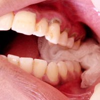 Пухлина після видалення зуба з кістою - скальпель - медичний інформаційно-освітній портал