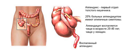 Complicații ale caracteristicilor caracteristice ale apendicităi, specii