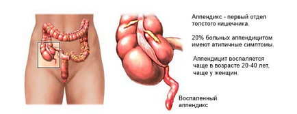 Ускладнення апендициту характерні ознаки, види