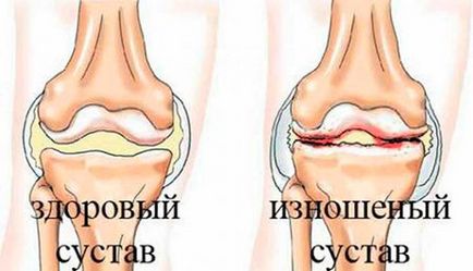 Osteoartrita și toate tipurile de tratament