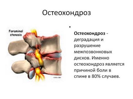 Остеохондроз грудного відділу хребта лікування в домашніх умовах