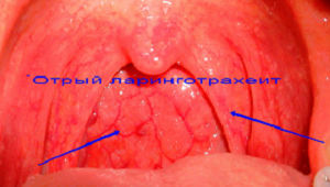 Гострий ларинготрахеїт у дітей симптоми і лікування