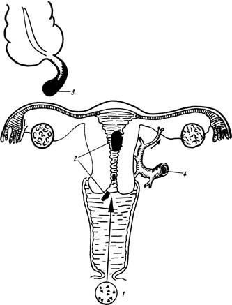 Inflamația acută a apendicelor - boli acute ale organelor cavității abdominale