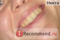 Whitening dinți buchsteiner albire n zâmbet - 