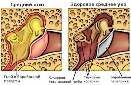 Отит у дітей симптоми і лікування, фото запалення