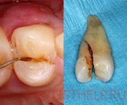 Tratamentul dentar fortat; Ce se poate face dacă dintele este despicat; restaurarea dinților ciupiți în Moscova,