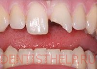 Tratamentul dentar fortat; Ce se poate face dacă dintele este despicat; restaurarea dinților ciupiți în Moscova,