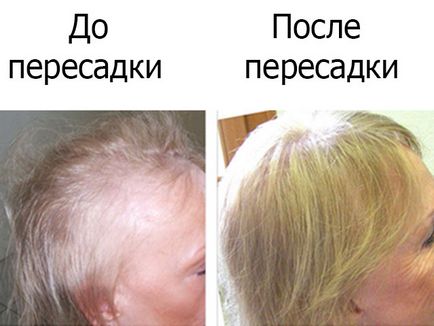 Звідки беруть волосся для пересадки з тіла на голову в чому небезпека пересадки штучного волосся