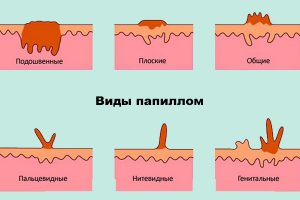 Папілома в паху у чоловіків і жінок види і методи лікування