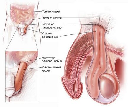 Herniile inghinale nu întârzie operația!