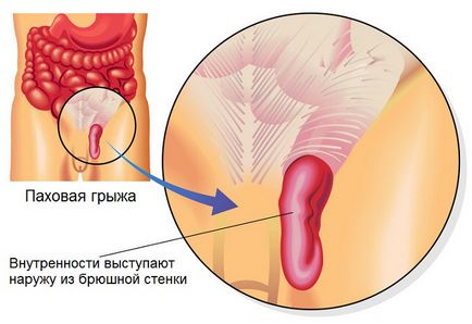 Herniile inghinale nu întârzie operația!