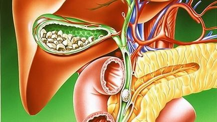 Înclinarea simptomelor vezicii biliare, tratamentul, dieta, portalul de sănătate despre sănătate