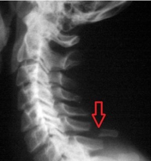 Fracturile proceselor spinoase ale vertebrelor - simptome, prim ajutor și tratament