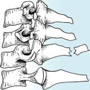 Fracturile proceselor spinoase ale vertebrelor - simptome, prim ajutor și tratament