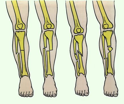 Fractura tibiei cu offset și fără diagnostic, tratament, reabilitare