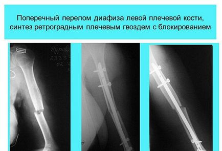 Fractura de humerus, imobilizare, cu deplasare, chirurgie, placă, reabilitare