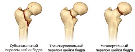 Перелом шийки стегна операція і реабілітаційний період