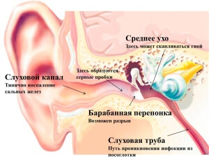 Perforarea simptomelor membranelor timpanice, a metodelor de tratament și posibilelor complicații