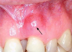A periodontitis gyermekeknél