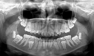 A periodontitis gyermekeknél