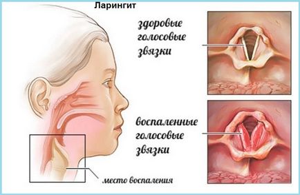 Чому постійно болить горло причини, що робити