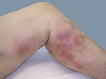 Чому ви відчуваєте біль в м'язах нижче коліна, ймовірні причини