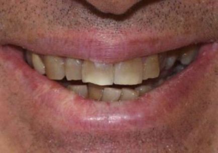 Чому зуби чорніють у дорослої людини