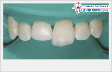 Abordări ale restaurării compozite directe a dinților frontali