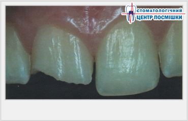 Підходи до прямої композитної реставрації фронтальних зубів
