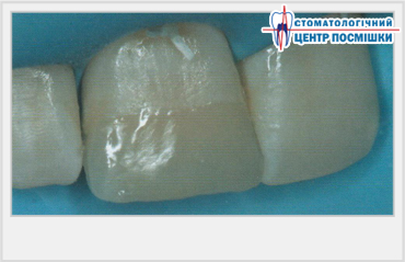 Підходи до прямої композитної реставрації фронтальних зубів