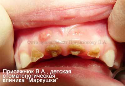Поразки зубів у дітей і способи їх відновлення в клініці «Маркушка»