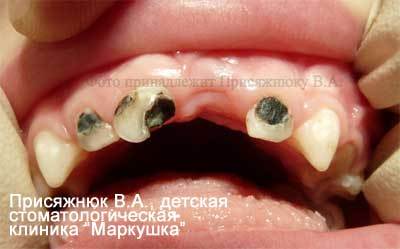Поразки зубів у дітей і способи їх відновлення в клініці «Маркушка»
