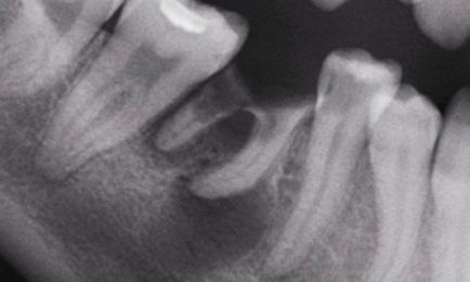 După extragerea dintelui, fragmentele rămânând, ce să facă
