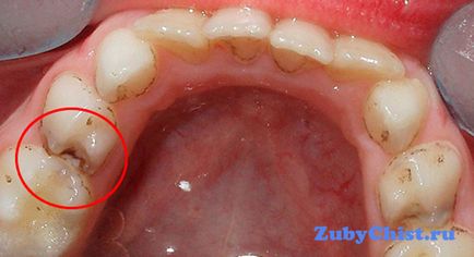 Carii superficiale diagnostic corect și tratament eficient