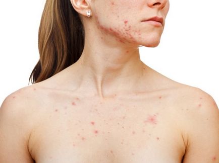 Cauze de acnee pe spate la femei - metode de tratament