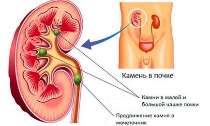 Профілактика каменів в нирках правила і рекомендації