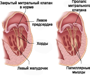 Prolapsul valvei mitrale - tratament, simptome și diagnostic