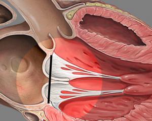 Simptomele prolapsului valvei mitrale, tratamentul, cauzele, diagnosticul