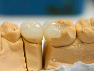 Протезування зубів, вініри і знімні протези в Бердянськ