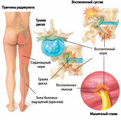 Radiculitis - clinica homeopatică 